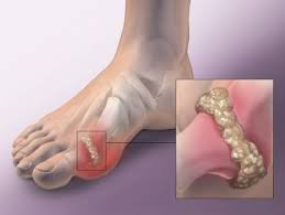 Illustration for article titled Obat Untuk Menyembuhkan Penyakit Asam Urat